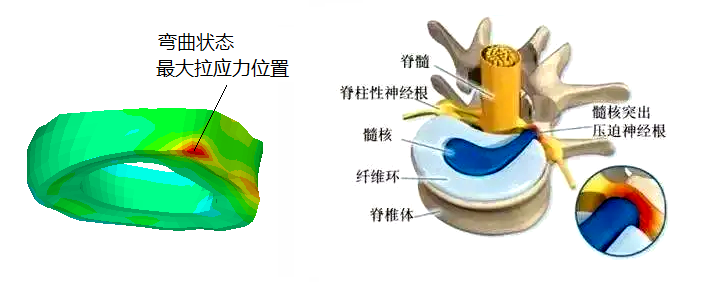 Lumbar_stress.png 腰椎间盘纤维环应力 腰椎间盘突出